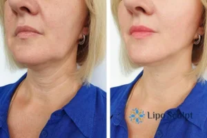 Double chin before and after Hi-Fu treatment 4 Book your double chin treatment Newark on Trent today! We are here to help!