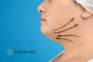Double chin before and after Hi-Fu treatment 3 Boost your confidence with a Double chin treatment Newark on Trent