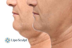 Double chin before and after Hi-Fu treatment 2 Double chin treatment Newark on Trent from Lipo Sculpt - feel more confident today!