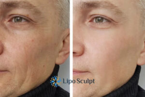 How to Fight Aging Symptoms 3 Fight Aging Symptoms Newark on Trent With HIFU and Morpheus8 Today!