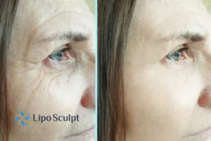 How to Fight Aging Symptoms 2 Do you want to Fight Aging Symptoms Newark on Trent? Contact Lipo Sculpt today!