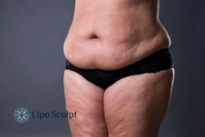 Cellulite's 5 Most Common Causes 4 Feel more confidence with your cellulite Newark on Trent treatment today!
