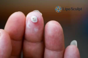 Cryopen Top 5 Treatable Conditions 4 Do you have a persistent wart of verruca that you cannot shit? Cryopen Newark on Trent treatment will work call us NOW!