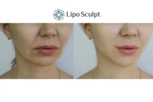 Explaining Total Skin Tightening Treatment And What It Can Do For You 2 Do you want to boost your self confidence? Give Morpheus8 Newark on Trent a try today!