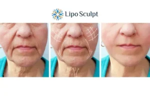 Explaining Total Skin Tightening Treatment And What It Can Do For You 3 Boost your confidence with Morpheus8 Newark on Trent call our team today!
