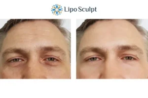 Explaining Total Skin Tightening Treatment And What It Can Do For You 6 Morpheus8 Newark on Trent book in today to find out more!