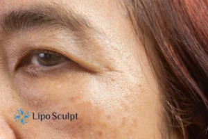 Cryopen: The Revolutionary Treatment for Age Spots Unveiled 2 Are age spots Newark on Trent giving you low self esteem? Contact us today!