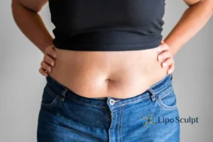Bidding Farewell to Muffin Tops with Aqualyx Fat Injections 2 Do you wish you could reduce your muffin top Newark on Trent With Aqualy fat dissolving injections you can!