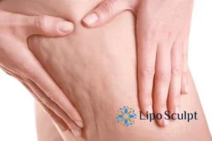 CoolSculpting for Legs: The Innovative Approach to Redefining Your Legs 5 Start your journey today book your coolsculpting treatment Newark on Trent online today!