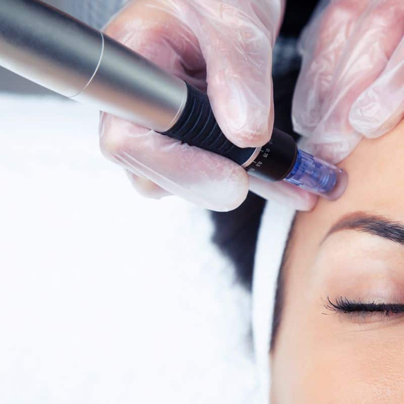 Morpheus8 treatment Newark on Trent from Lipo Sculpt - Book in today!