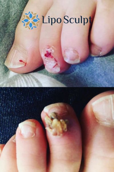 Wart removal customer results from Lipo Sculpt Newark on Trent