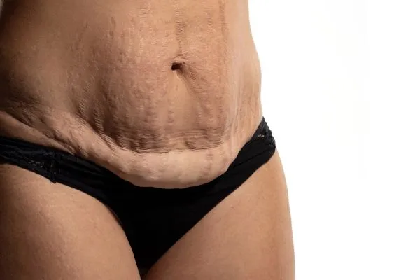 Lost the Weight but Not the Loose Skin? 1 image of womans stomach after weight loss showing loose skin Newark on Trent